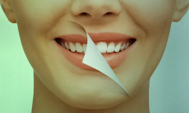 Clareamento dental
